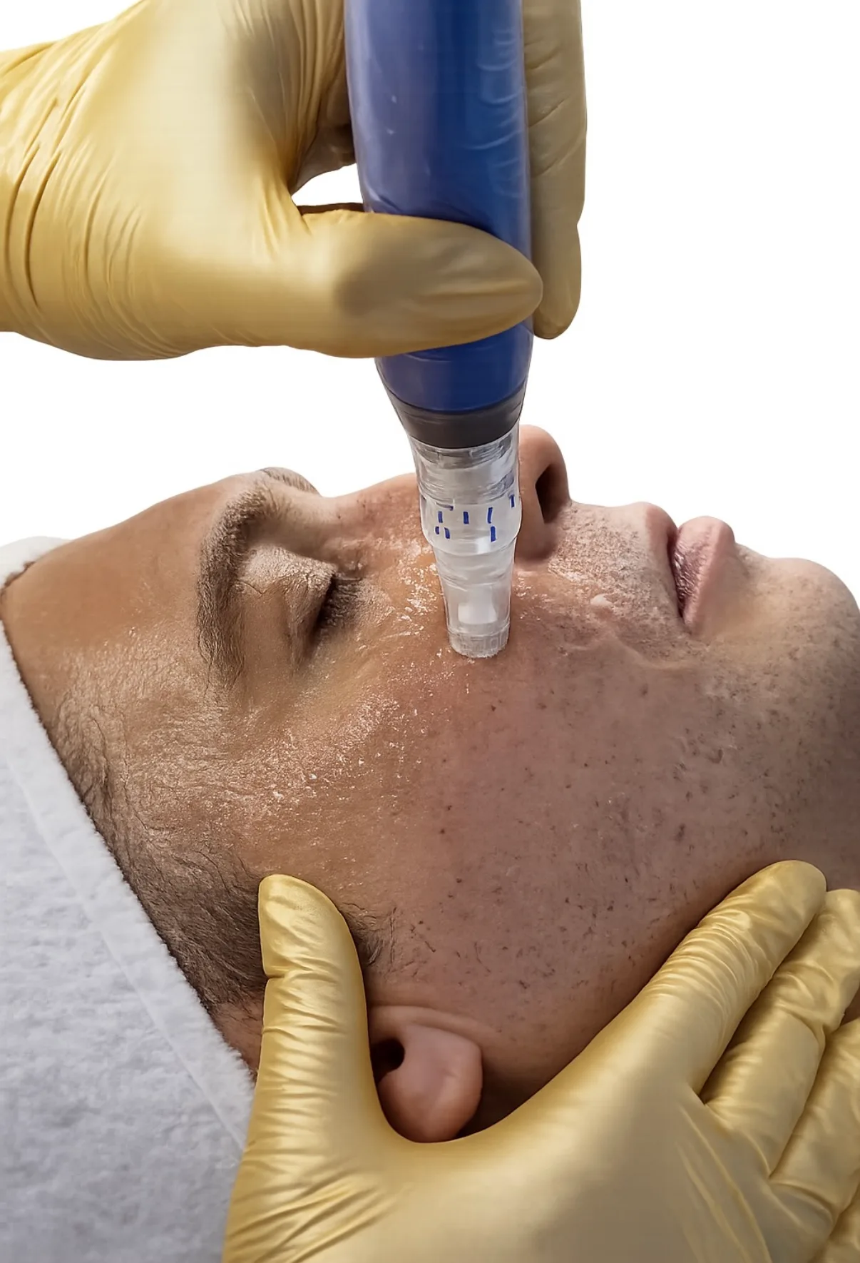 Kozmetičarka Crystal Estetskega centra izvaja SkinPen microneedling obravnavo