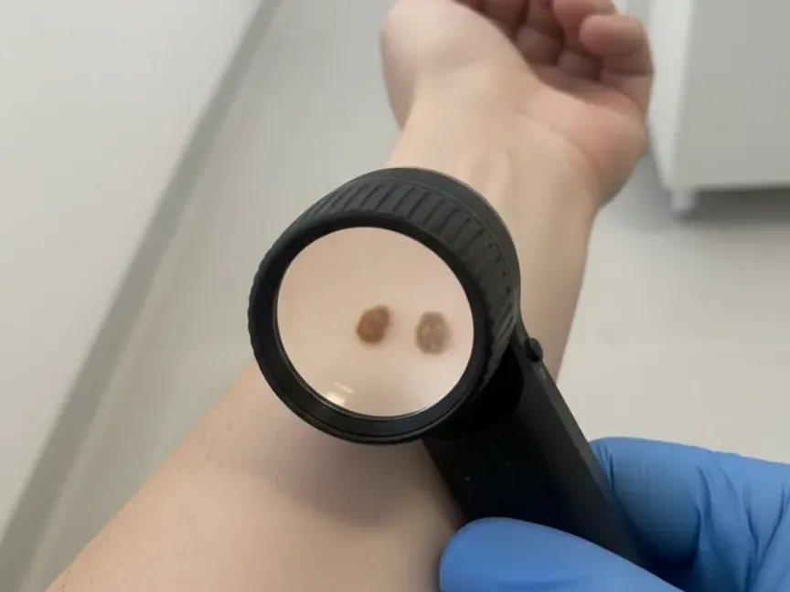 Dermatoskopski pregled znamenj na podlakti
